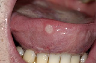 Klar, hvidfarvet mavesår på spidsen af tungen