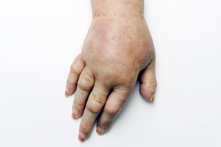 Strakt hud på hånd og arm forårsaget af ødem