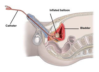 Diagram over et boligkateter (Foley-kateter)