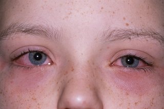 Billede af allergisk konjunktivitis