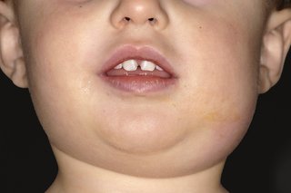 Et barn med et hævet ansigt forårsaget af fåresyge.