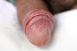 En penis med rød, irriteret hud