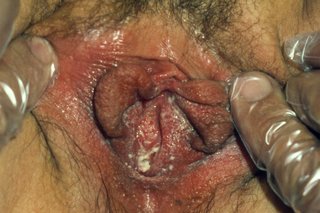 En vagina med hvid udflåd