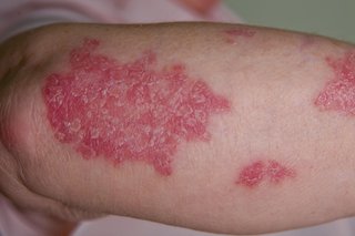 Plaque psoriasis udslæt.