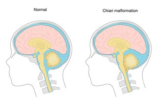 Diagram, der viser en Chiari-misdannelse