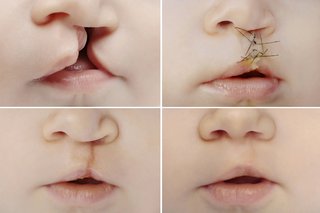 Billeder af spaltet læbe før og efter operationen