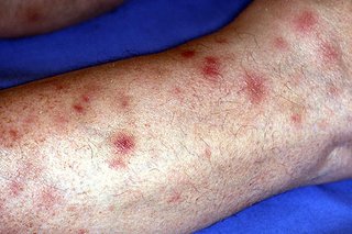 Erythema nodosum buler og pletter