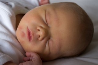 Billede af nyfødt baby med gul hud.