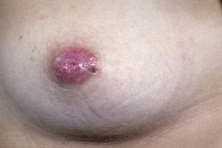 Billede af kvinde med Pagets sygdom i brystvorten
