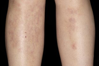 Erythema nodosum støder på skinnebenene