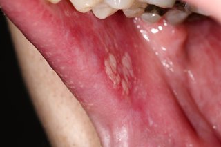Hvide pletter af lichen planus i munden.