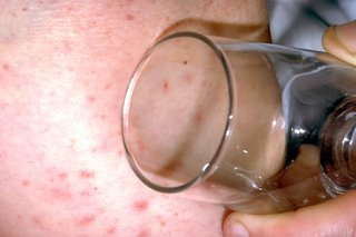 Billede af meningitis udslæt på hvid hud med glas holdt imod det