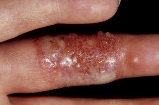 Blærer på fingeren forårsaget af herpesvirus