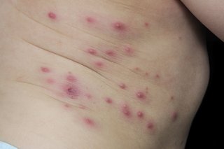 Impetigo blærer på et ungt barns torso