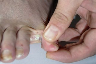 Hvidt plaster mellem tæerne forårsaget af atletens fod