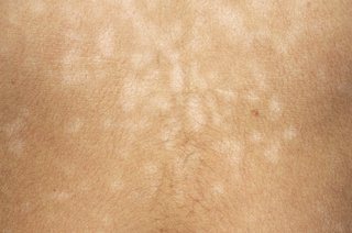 Mørk hud med mindre lysere pletter forårsaget af pityriasis versicolor.