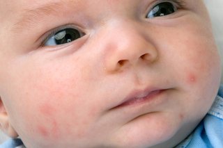 Acne på babyens ansigt